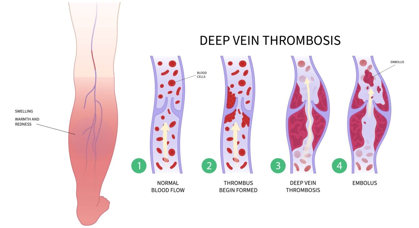 Vein Removal